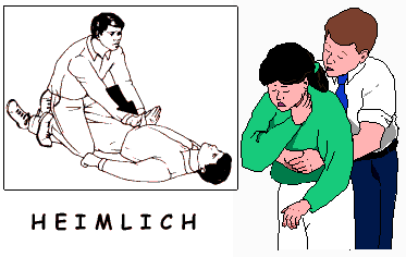 maniobra de Heimlich